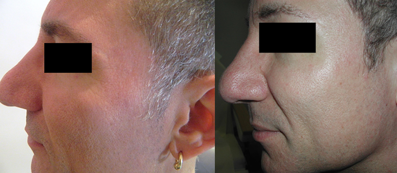 Before Fraxel - Sun Damage with large pores (left) After 1 month post Fraxel #3 (right)