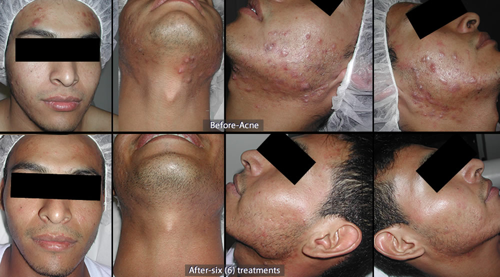 Before-Acne (above) and After-six (6) treatments (below). 