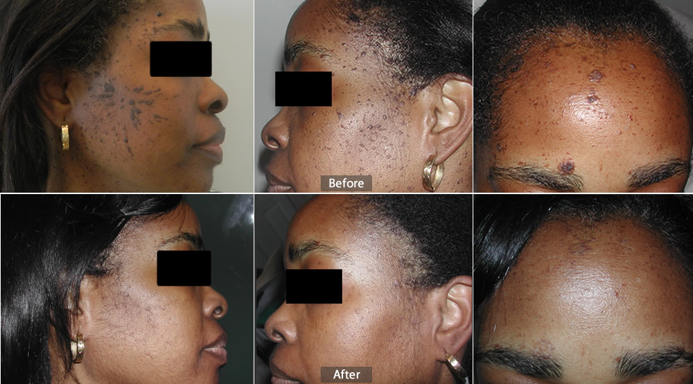 before and after photos for fraxel laser