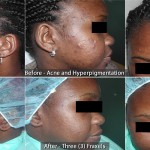 Before – Acne and Hyperpigmentation & After – Three (3) Fraxels