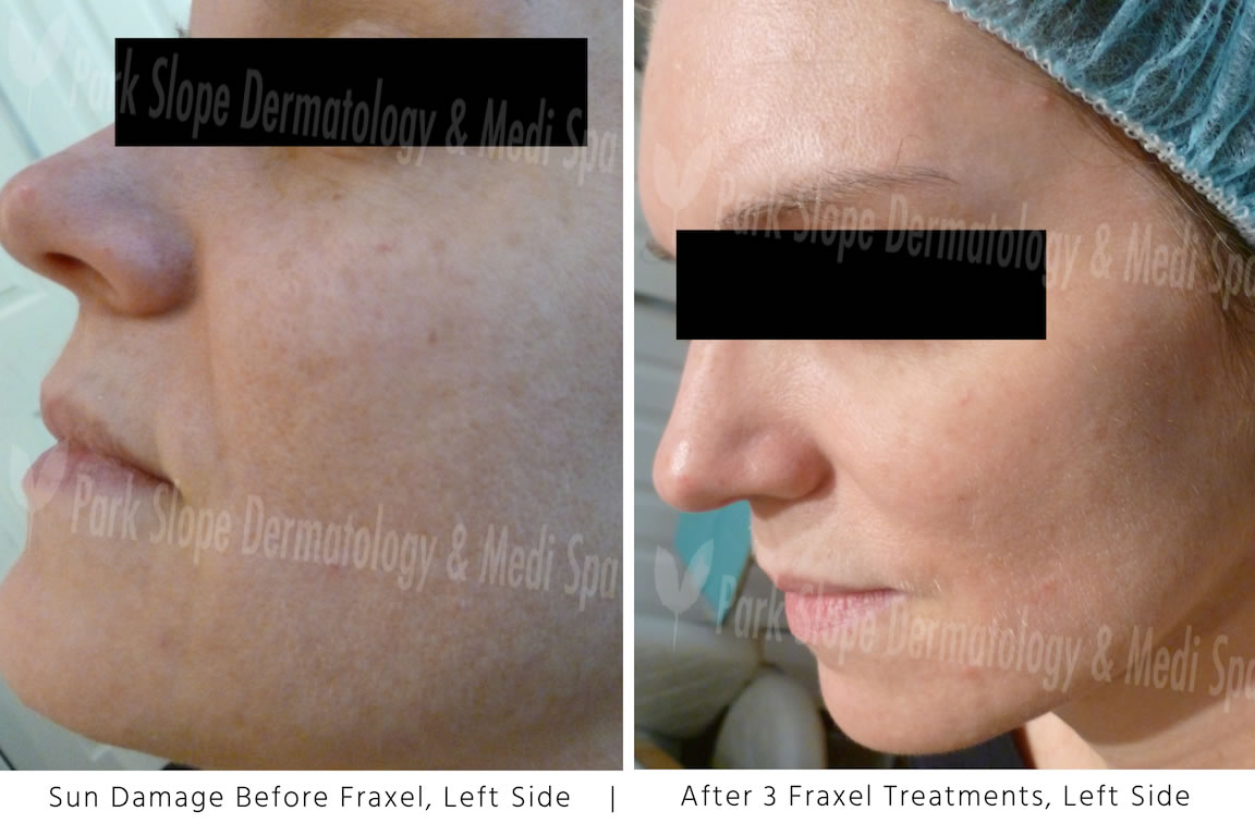 Sun Damage Before and After Fraxel Left Side