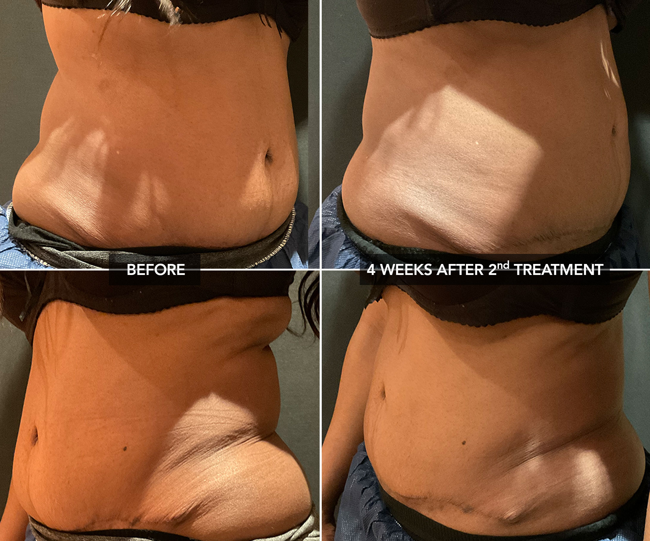 Abdomen (lateral) Before & After Coolsculpting