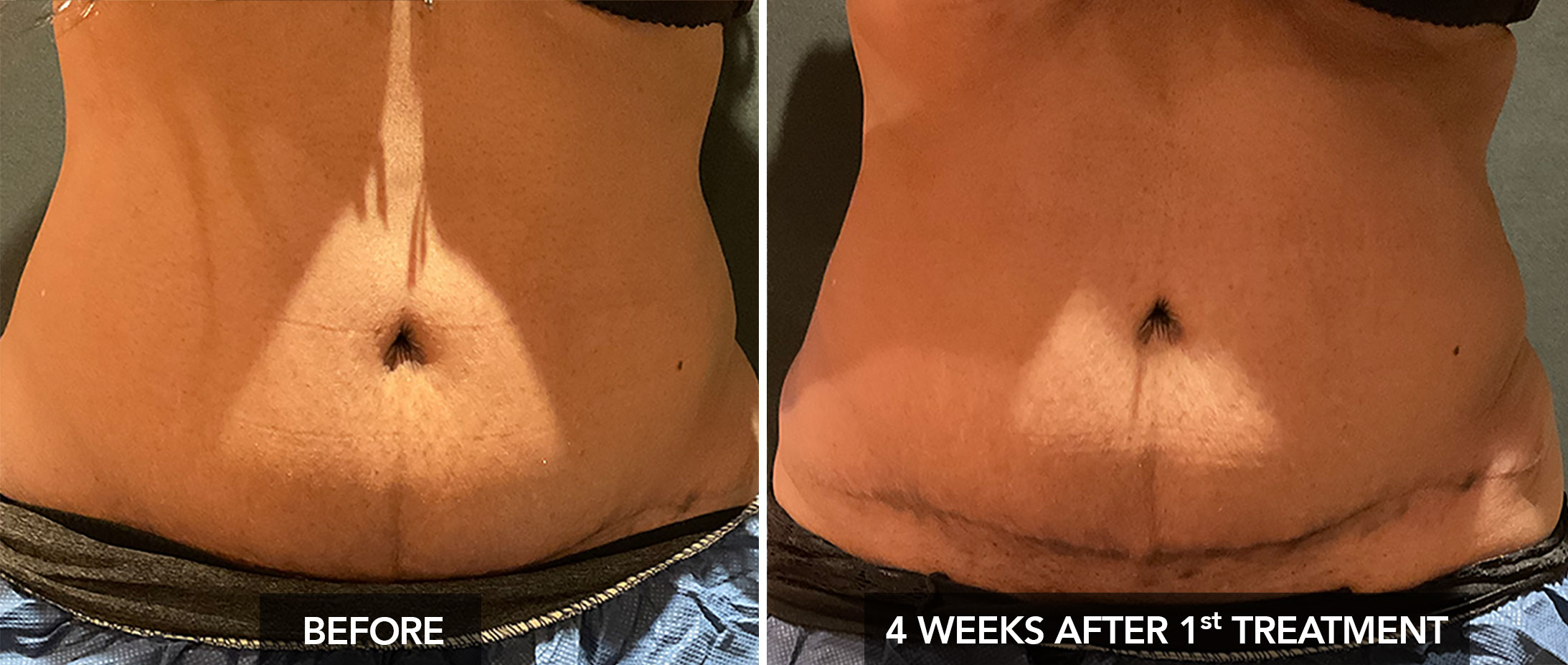 Abdomen Before & After Coolsculpting