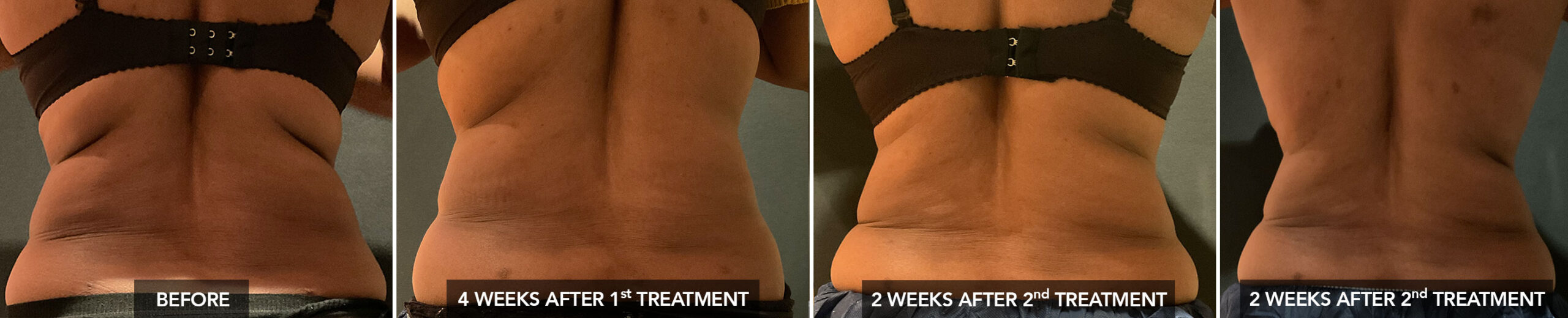 Back Fat Before & After Coolsculpting