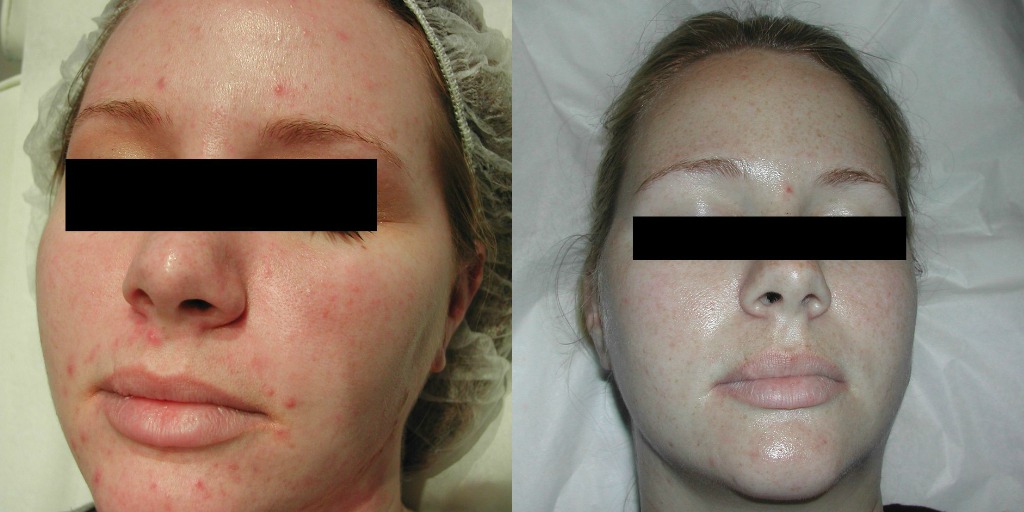 Before Chemical Peels- Acne (left) After 5 Vitalize Peels-Glycolic Acid Peels (right)