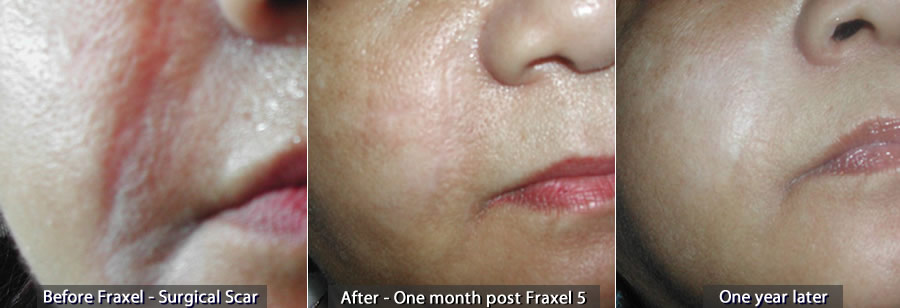 Before Fraxel Surgical Scar (left) -- After 1 month post Fraxel 5 (center) -- One year later (right)