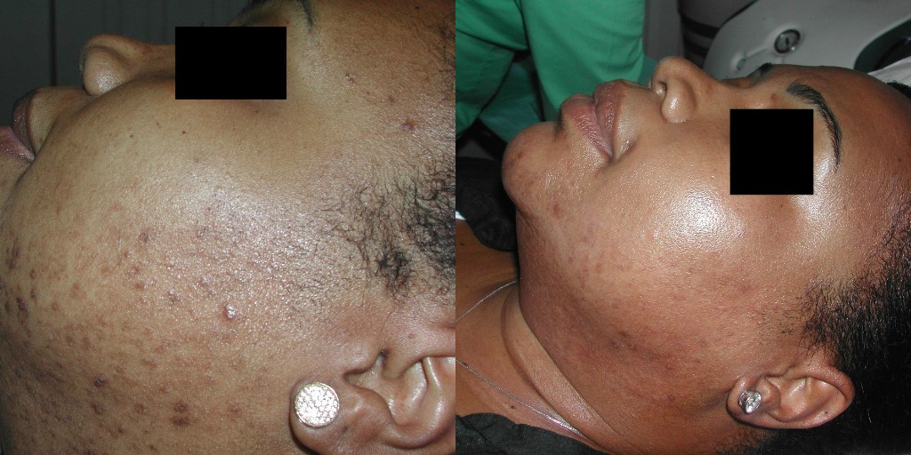 Before Vitalize Peels- Acne (left) After 6 Vitalize Peels (right)