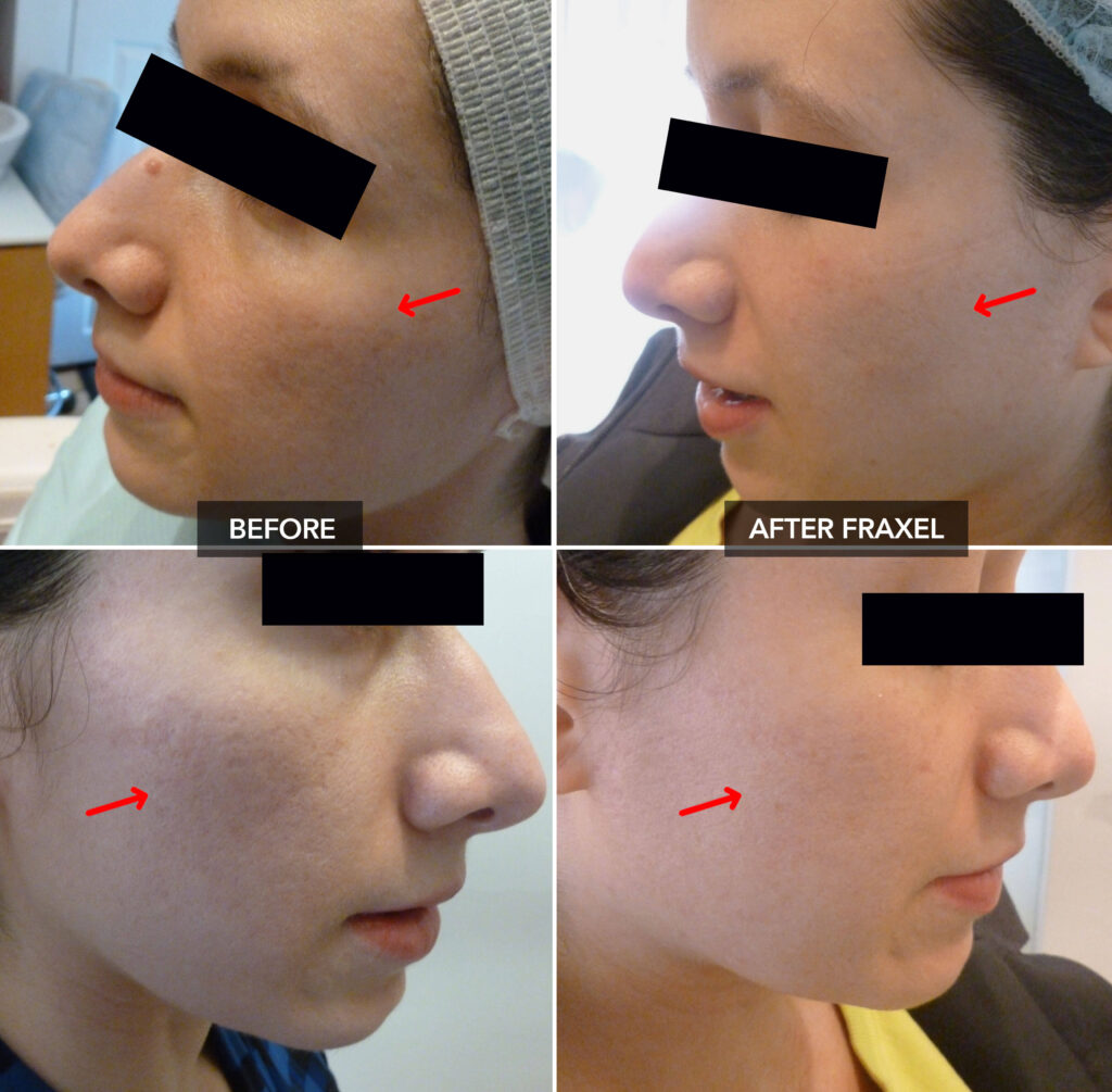 Acne Scarring - Before & After Fraxel