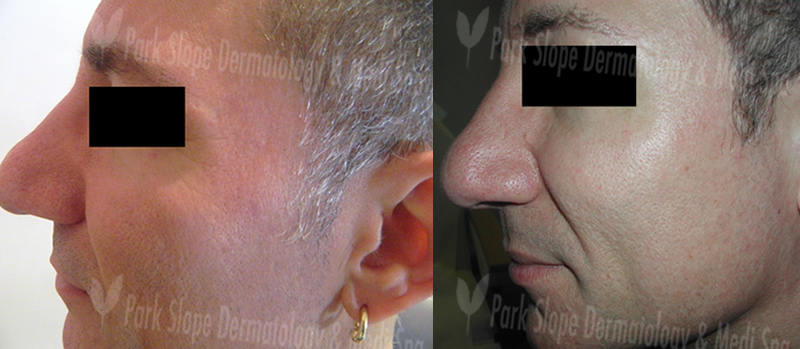 Before Fraxel – Sun Damage with large pores (left) After 1 month post Fraxel #3 (right)