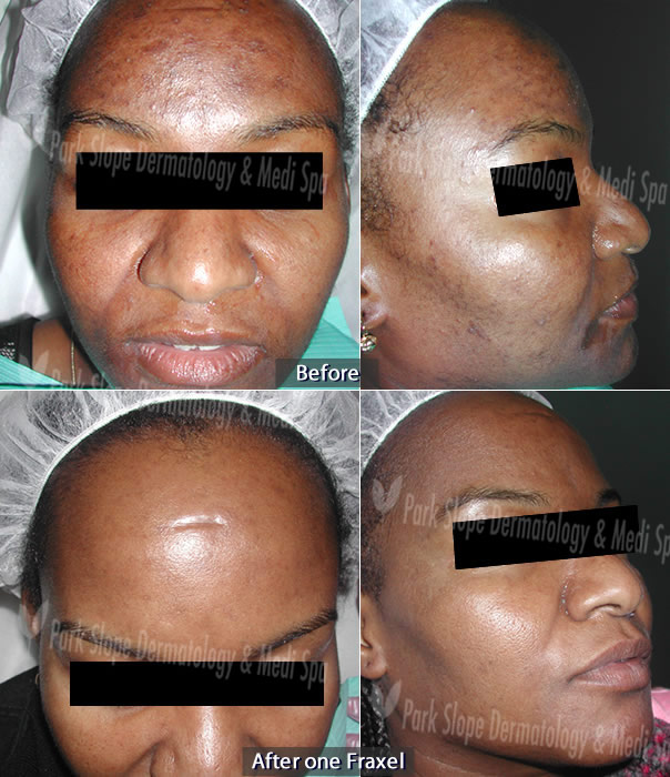 Before – Hyperpigmentation & After – One (1) Fraxel
