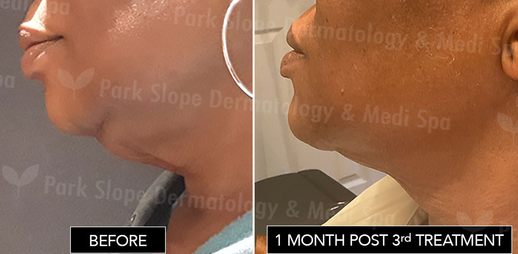 Coolsculpting Submental Fat - Before / After 1 month post 3rd treatment