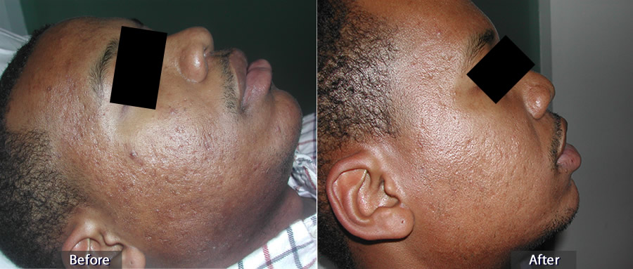 Acne Scarring Before (left) & After (right)
