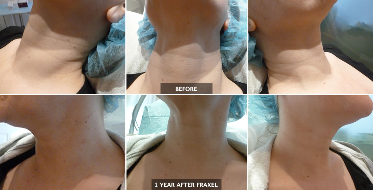 Fraxel neck tightening & resurfacing - after 3 sessions