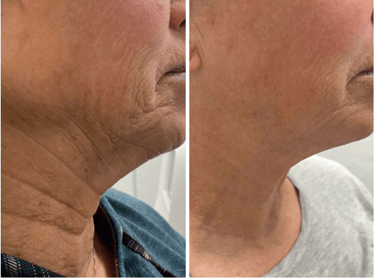 Before & After Virtue RF Microneedling