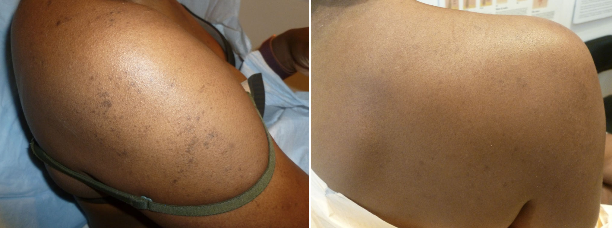 Body hyperpigmentation before and after Fraxel laser