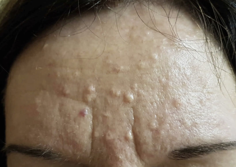 Forehead: sebaceous hyperplasia, treated with Fraxel laser