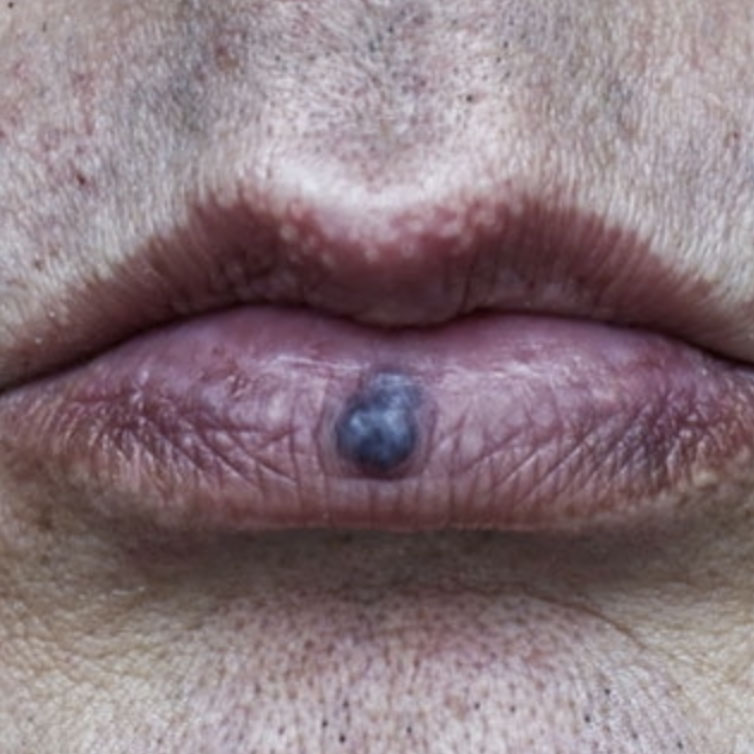 Lips: lip enhancement: Botox, Fillers