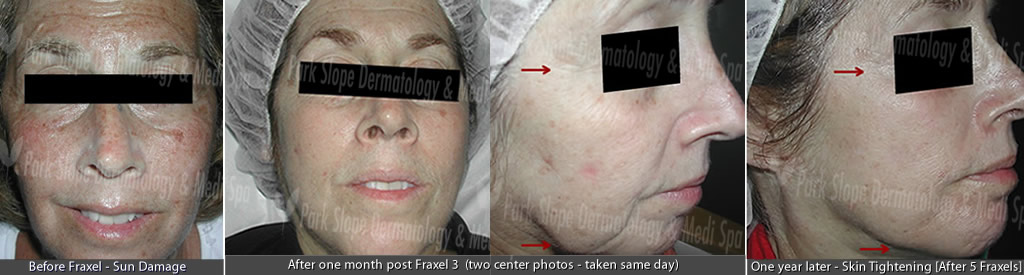 BEFORE FRAXEL – SUN DAMAGE  (LEFT) — AFTER 1 MONTH POST FRAXEL #3 (BOTH CENTER PICS) — ONE YEAR LATER AFTER 5 FRAXELS (RIGHT)
