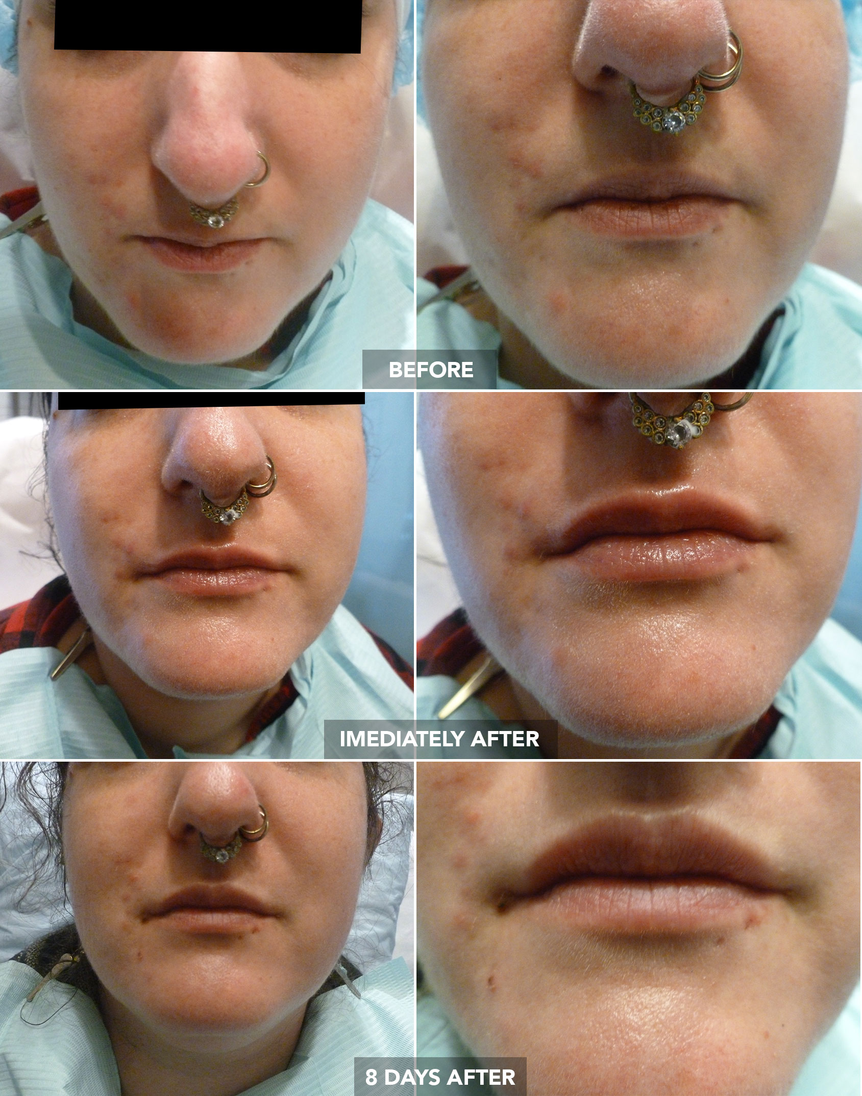 LIP AUGMENTATION – BEFORE / IMMEDIATELY AFTER / AFTER 8 DAYS
