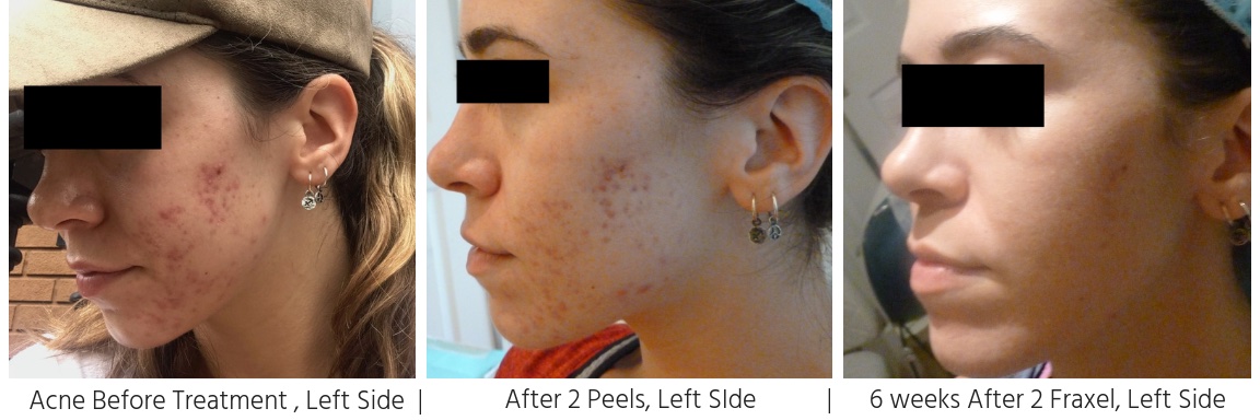 ACNE & SCARRING BEFORE TREATMENT, LEFT SIDE