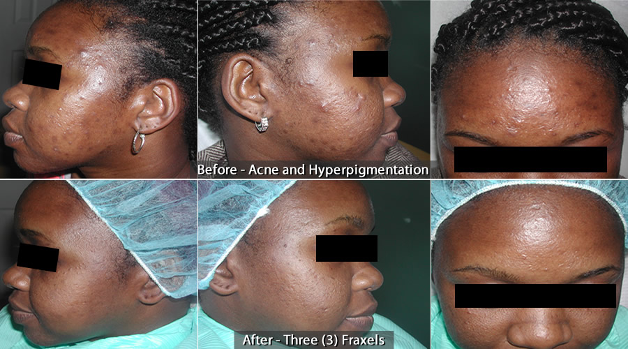 BEFORE – ACNE AND HYPERPIGMENTATION & AFTER – THREE (3) FRAXELS