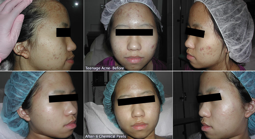 BEFORE – TEENAGE ACNE (TOP) & AFTER 6 CHEMICAL PEELS (BOTTOM)