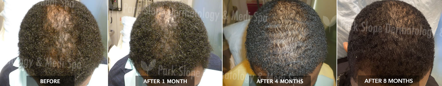 ALOPECIA / HAIR LOSS – BEFORE / AFTER 1 MONTH / 4 MONTHS / 8 MONTHS AFTER 1ST TREATMENT