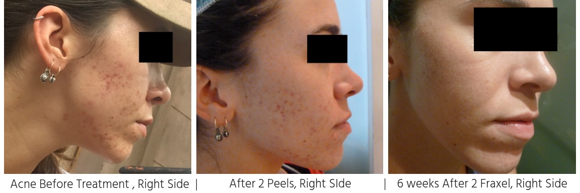 ACNE & SCARRING BEFORE TREATMENT, RIGHT SIDE