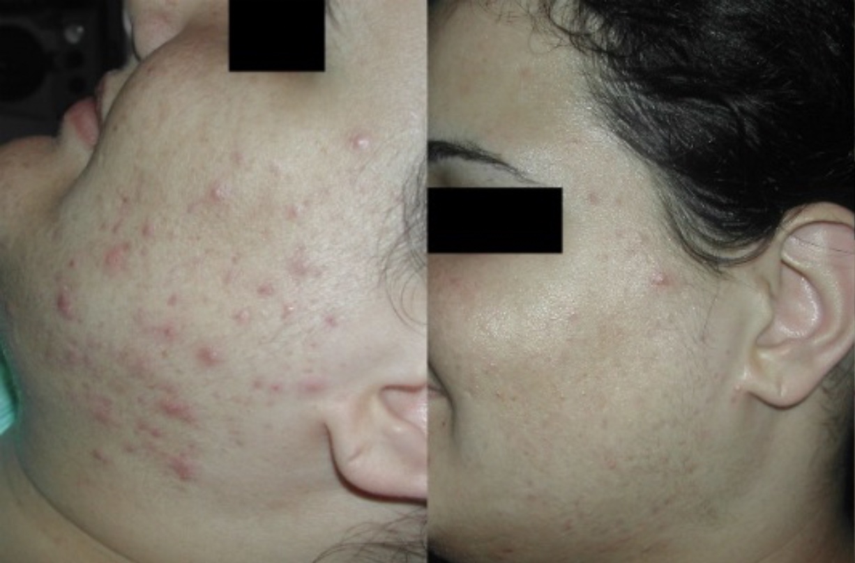 BEFORE VITALIZE PEEL-ACNE (LEFT) AFTER #3 VITALIZE PEEL (RIGHT)