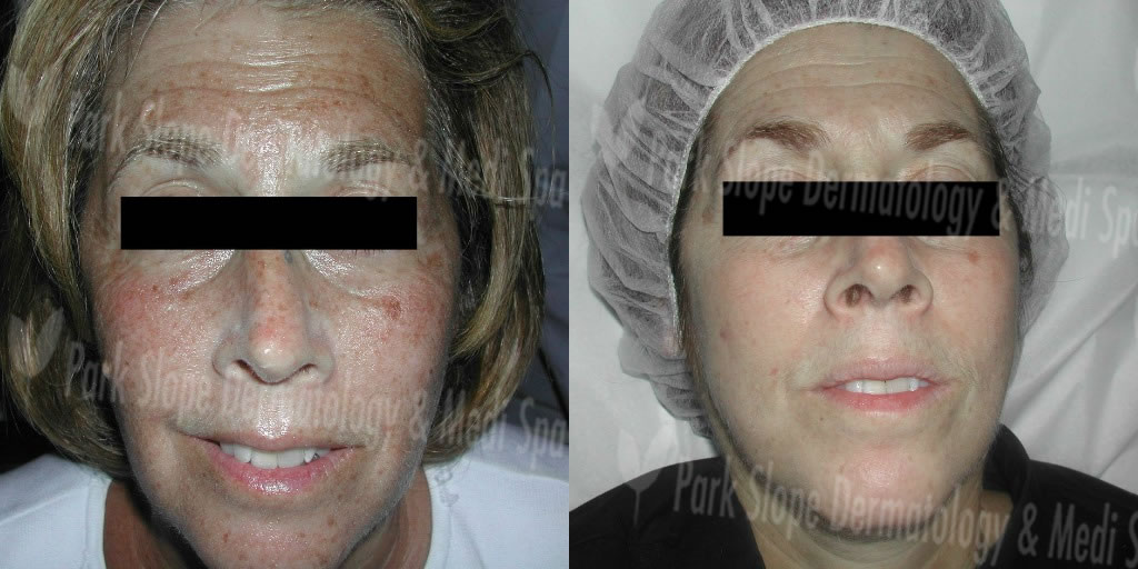 BEFORE FRAXEL – SUN DAMAGE (LEFT) — AFTER 1 MONTH POST FRAXEL #3 (RIGHT)