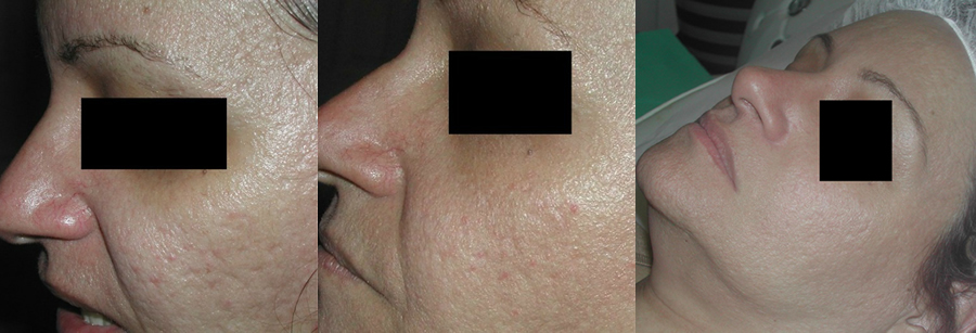 BEFORE FRAXEL- ACNE SCARRING (LEFT) AFTER 1 MONTH POST FRAXEL #3 (MIDDLE) AFTER 3 MONTHS POST FRAXEL #6 (RIGHT)