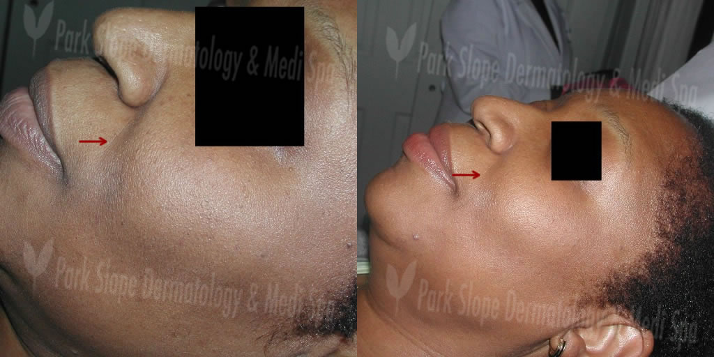 BEFORE FRAXEL – HYPERPIGMENTATION (LEFT) AFTER 1 MONTH POST FRAXEL #1(RIGHT)