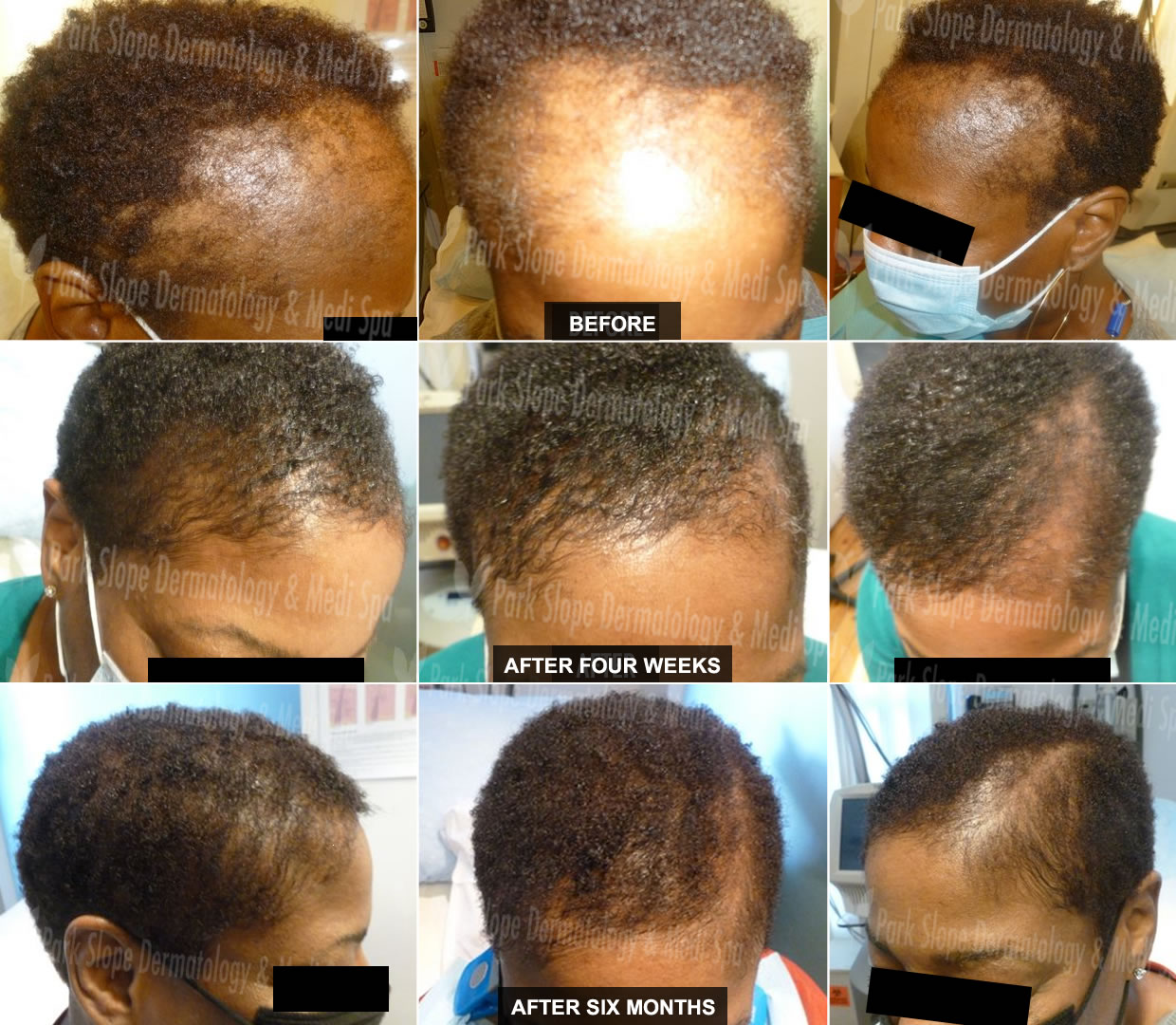 ALOPECIA / HAIR LOSS – BEFORE / AFTER 4 WEEKS POST 2ND TREATMENT / 6 MONTHS AFTER 1ST TREATMENT
