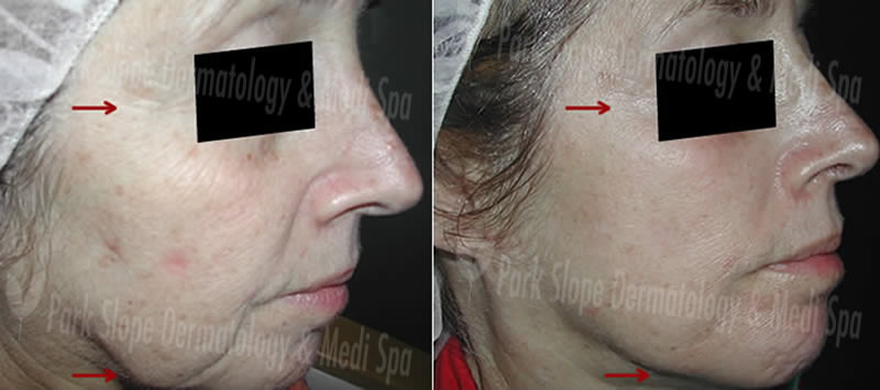 BEFORE FRAXEL-SUN DAMAGE (LEFT) — ONE YEAR LATER – SKIN TIGHTENING [AFTER 5 FRAXELS] (RIGHT)