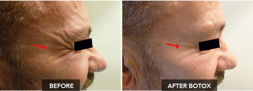 CROWS FEET BEFORE / AFTER BOTOX