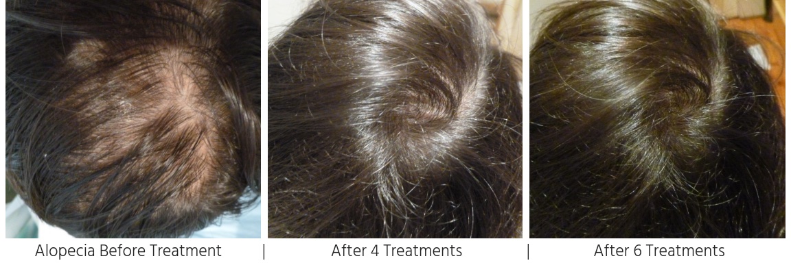 ALOPECIA / HAIR LOSS – BEFORE AND AFTER TREATMENT