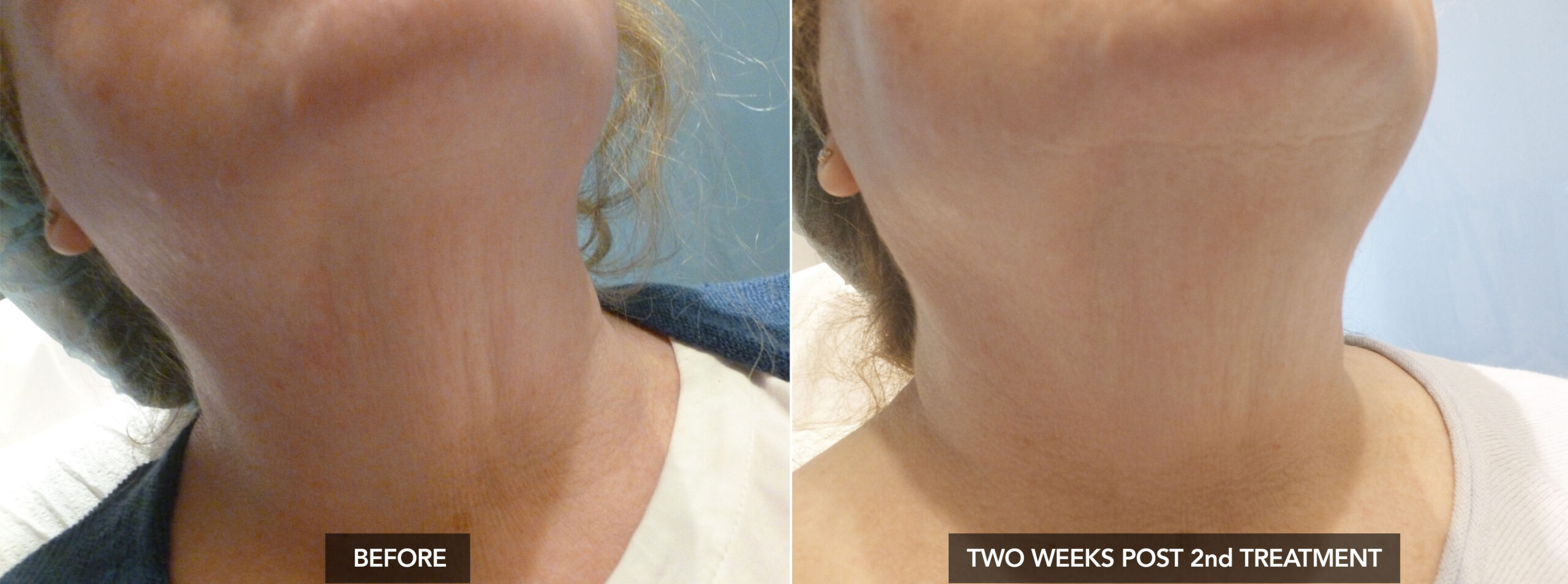 VIRTUERF NECK BEFORE & TWO WEEKS AFTER 2ND TREATMENT