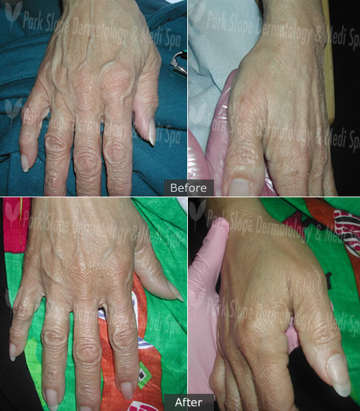 HANDS – BEFORE (TOP) & AFTER ONE (1) FRAXEL (BOTTOM)