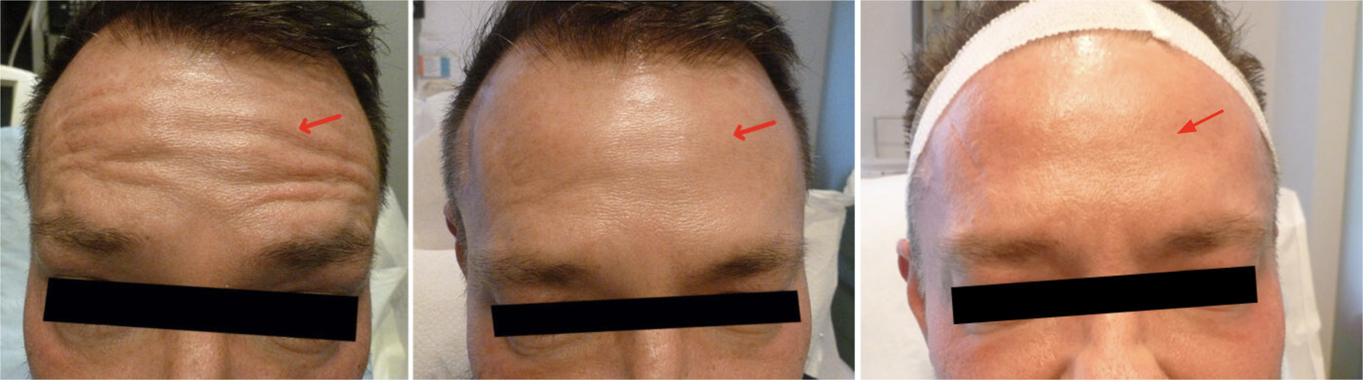 FOREHEAD BEFORE / AFTER BOTOX