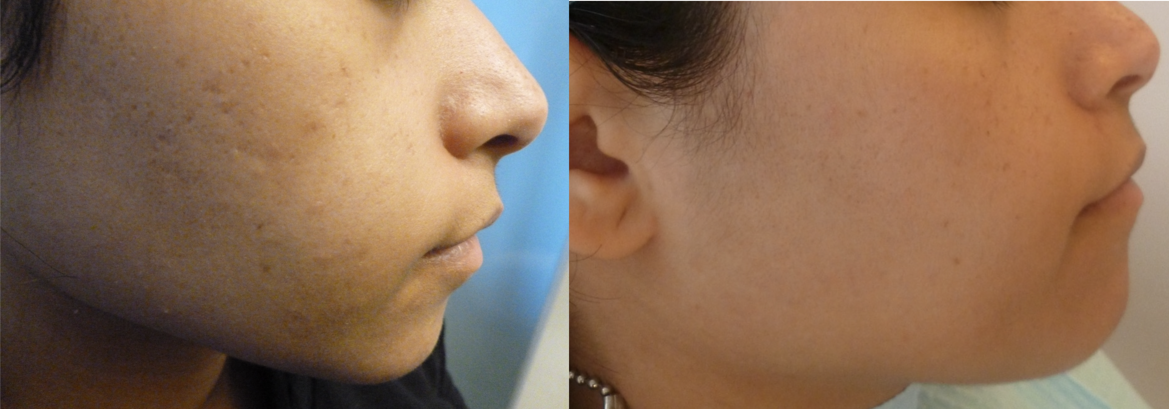 BEFORE FRAXEL – ACNE SCARRING (LEFT), 1 MONTH POST AFTER FRAXEL #4 (RIGHT)