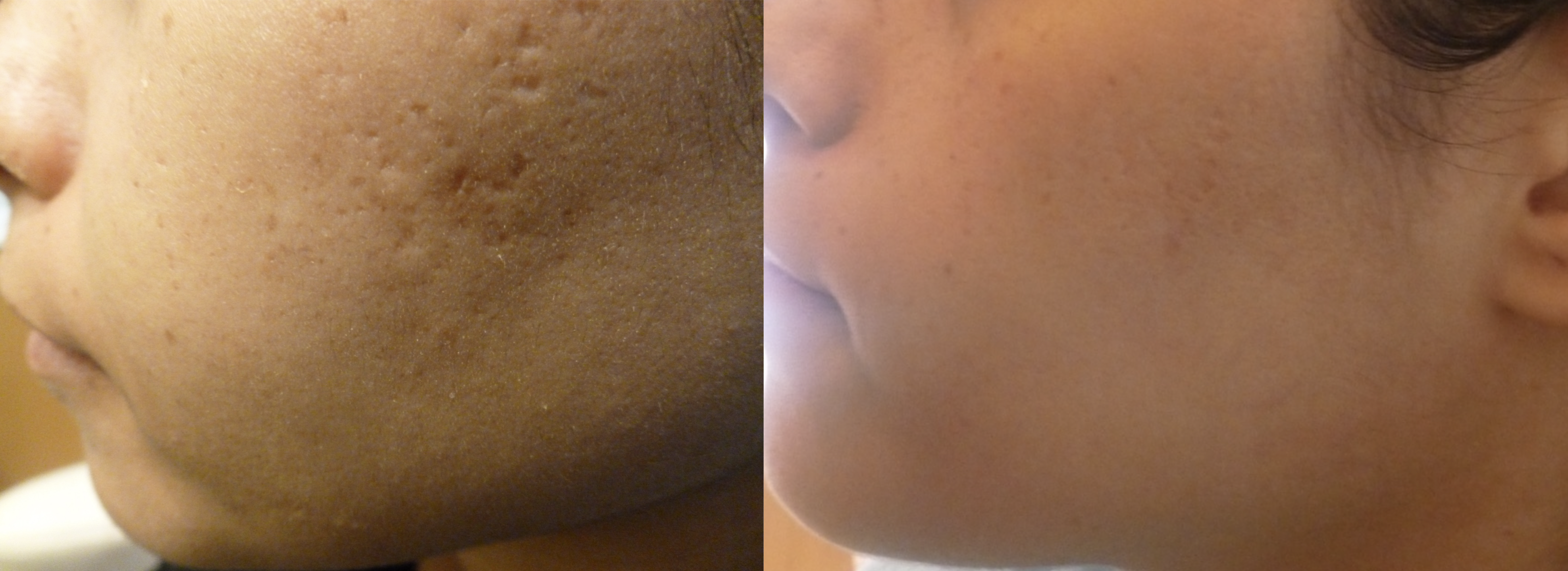 BEFORE FRAXEL – ACNE SCARRING (LEFT), 1 MONTH POST AFTER FRAXEL #4 (RIGHT)