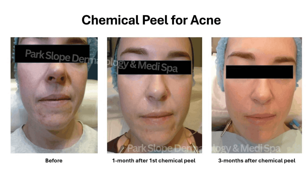 Before and after chemical peel for treating acne
