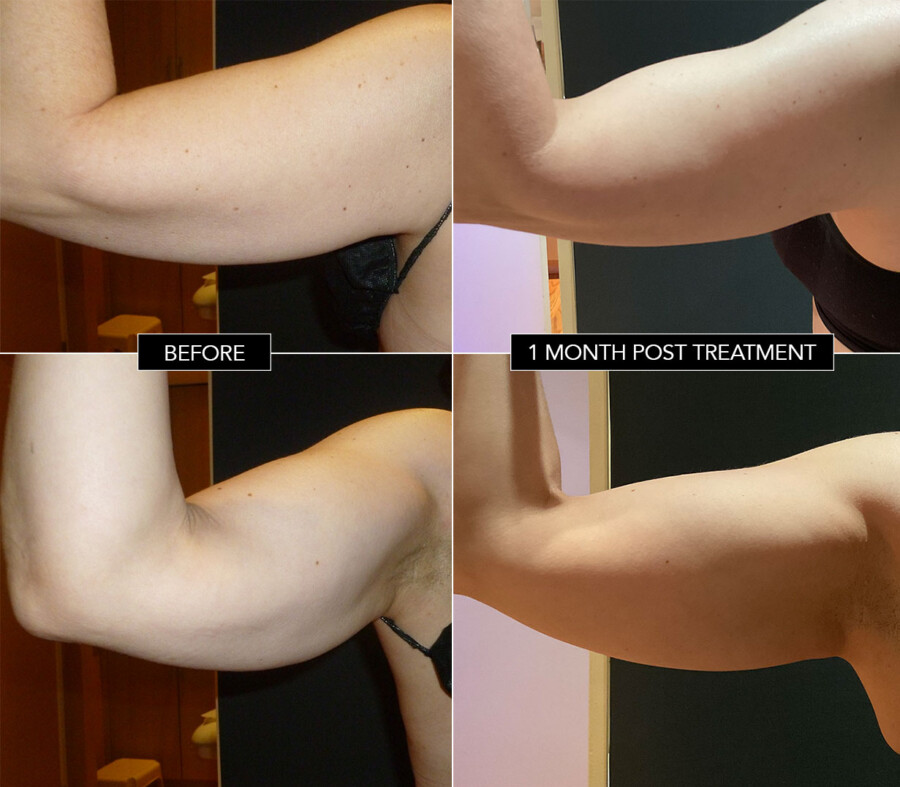 Coolsculpting Arms Before & 1 month post treatment Coolsculpting Arms Before & 1 month post treatment