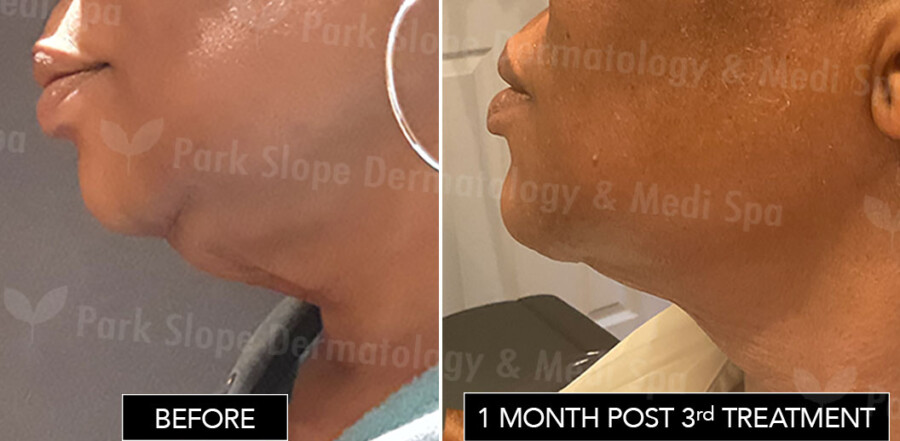 Coolsculpting Submental Fat - Before / After 1 month post 3rd treatment Coolsculpting Submental Fat - Before / After 1 month post 3rd treatment