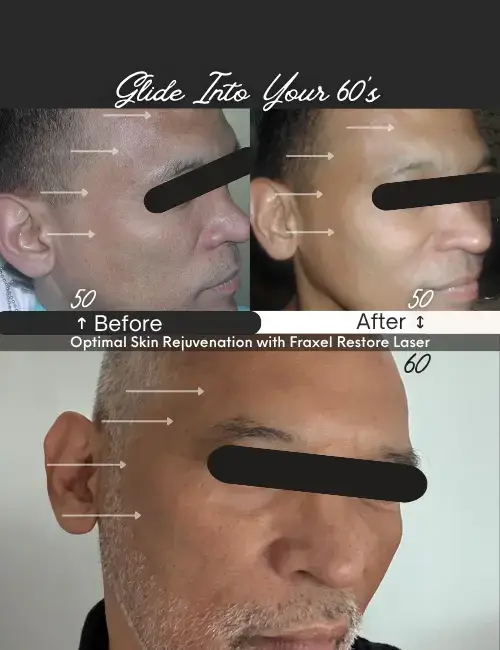 Skin rejuvenation with fraxel laser at Park Slope dermatology in Brooklyn